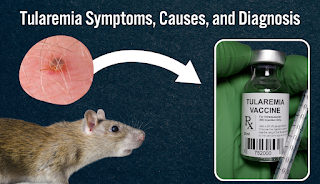 Tularemia: A Rare but Potentially Severe Infectious Disease